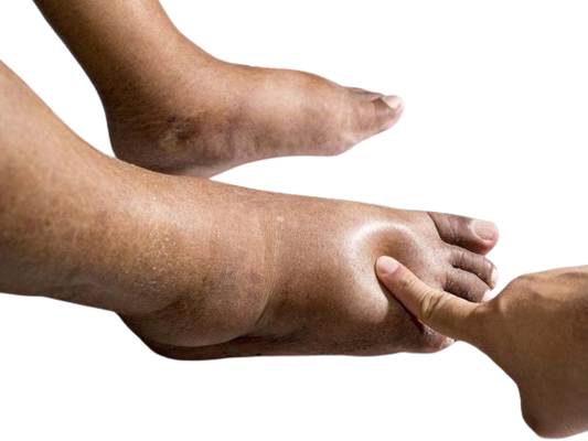 Diabetic Foot Problems